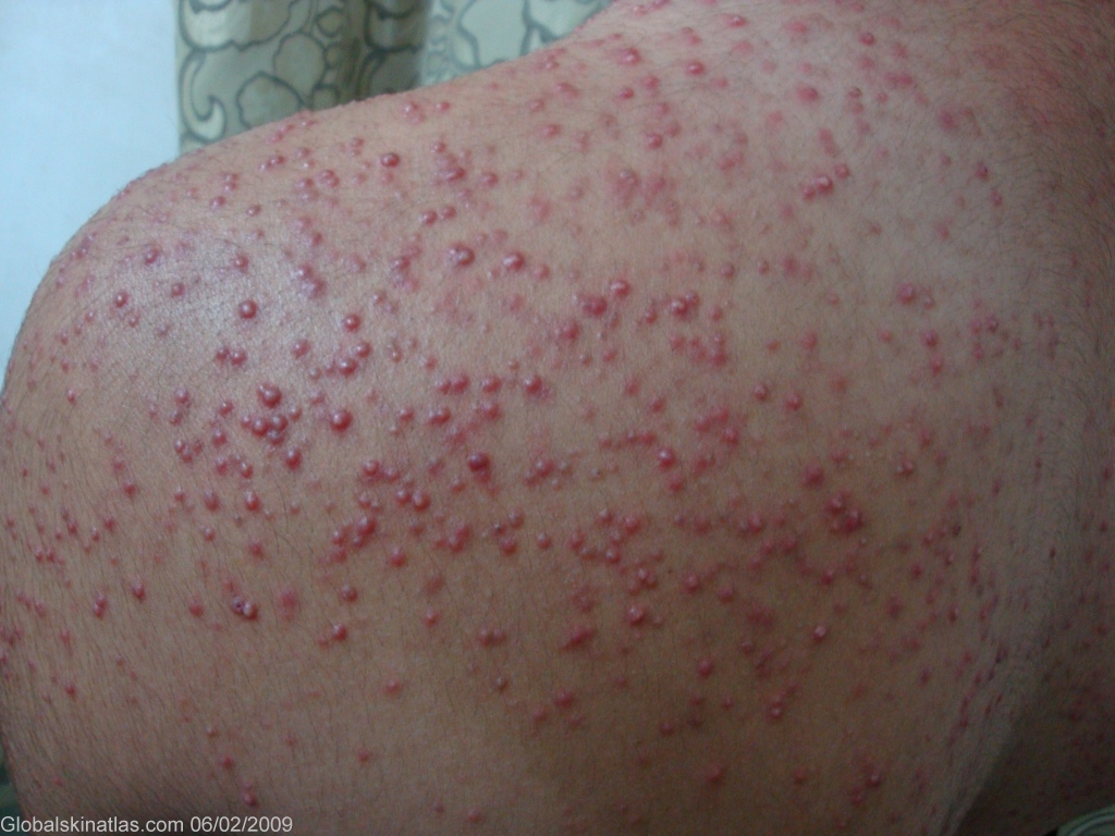 Common Skin Infections